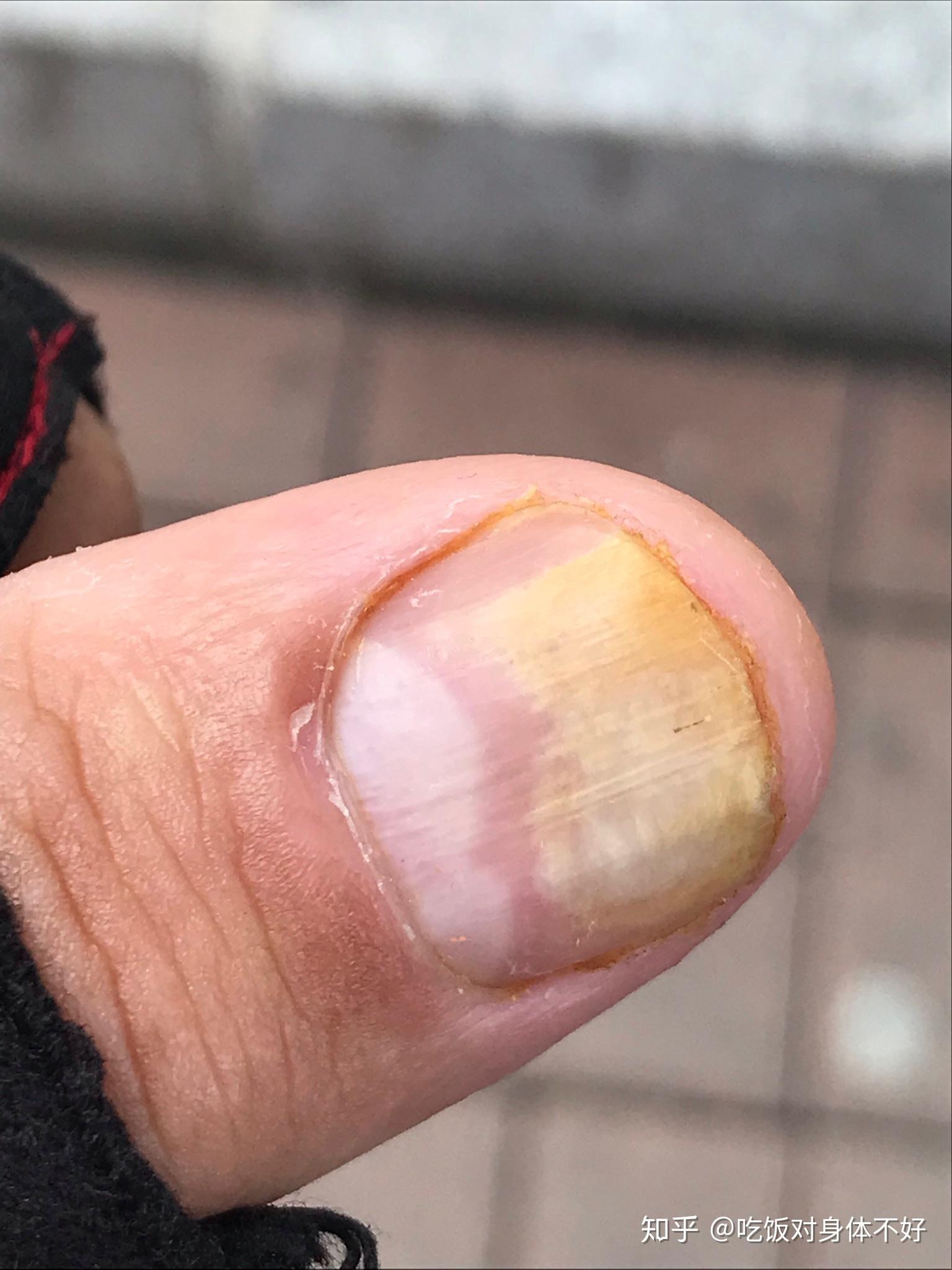指甲分离症的图片(指甲分离症的图片对比)
