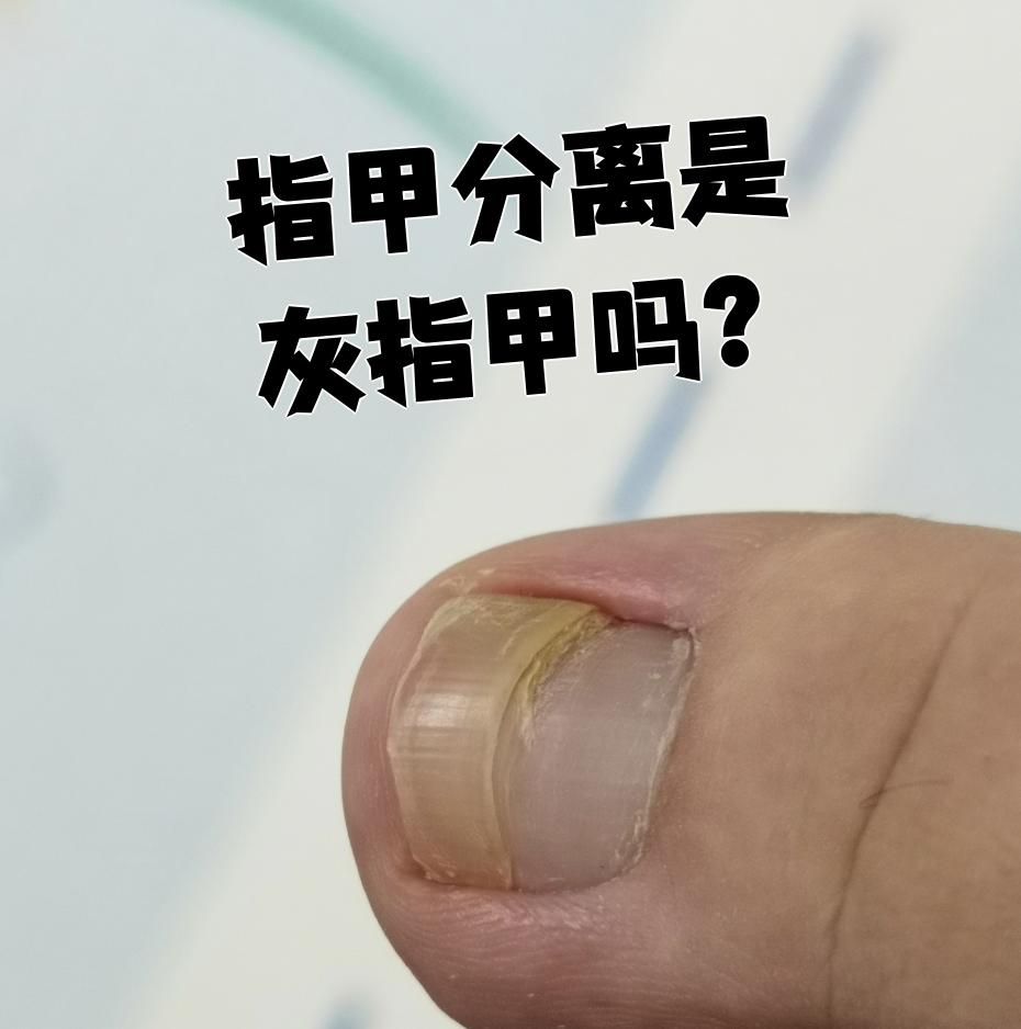 指甲分离症的图片(指甲分离症的图片对比)