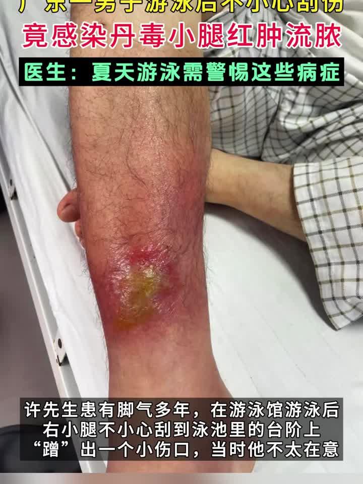 丹毒早期图片(丹毒早期图片丹毒可除根吗)