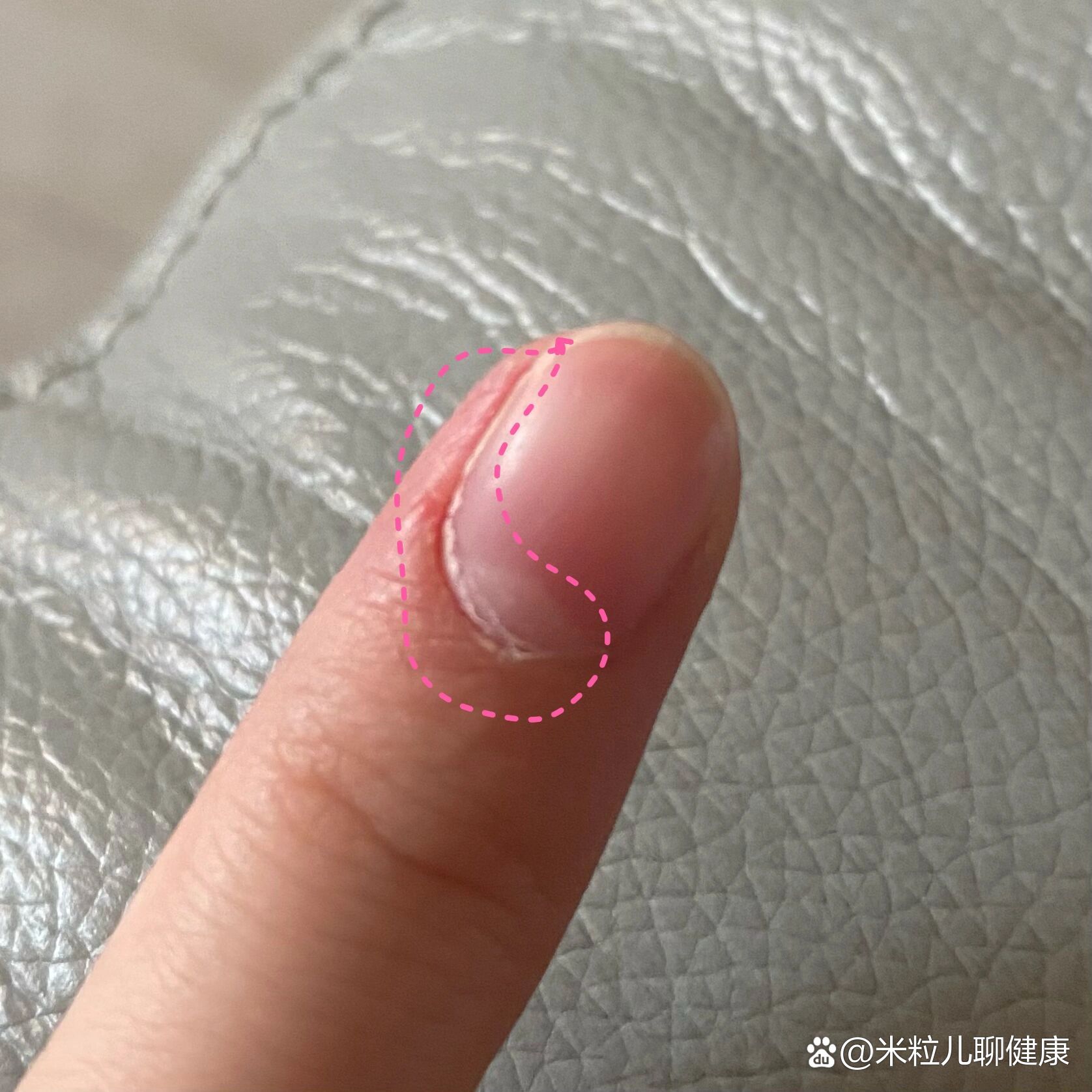 手指甲盖和肉分离图片的简单介绍
