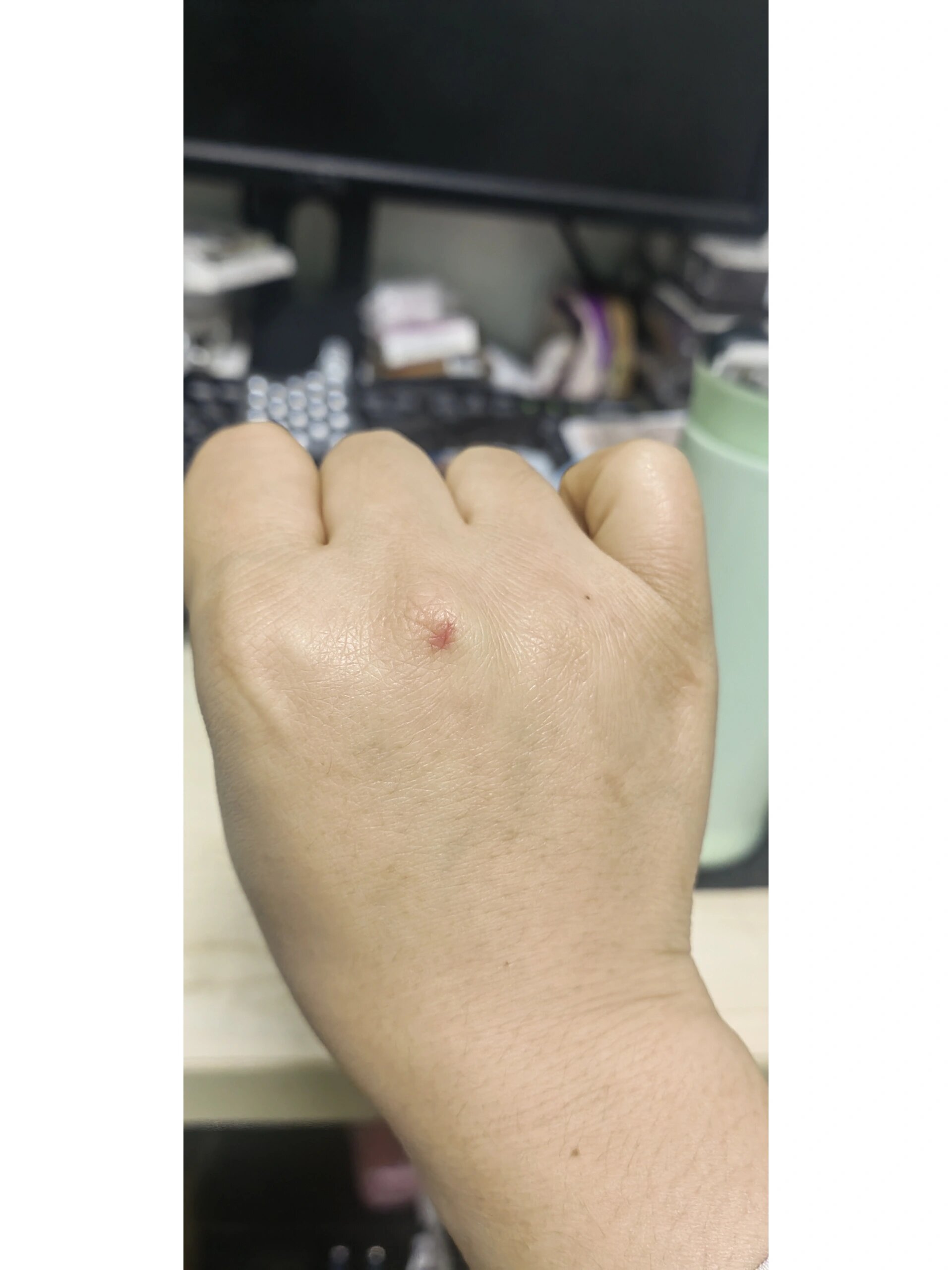 艾滋病手背红疹图片(hpv感染红疹子图片) 艾滋病手背红疹图片(hpv感染红疹子图片)