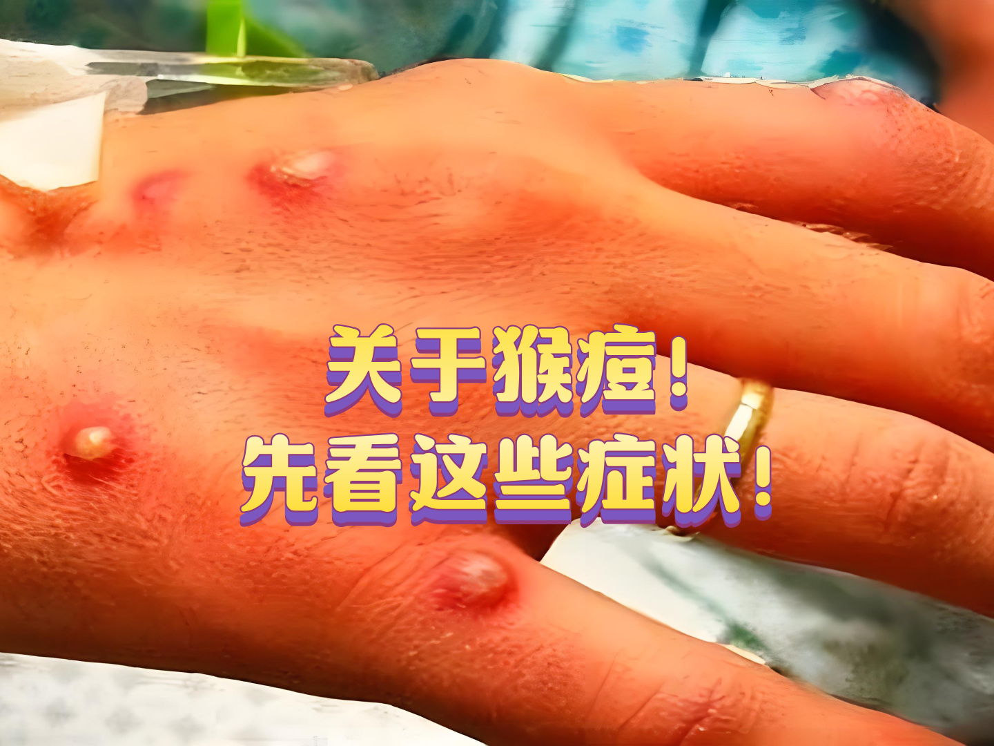 重庆现猴痘病例吴尊友发文回应的简单介绍 重庆现猴痘病例吴尊友发文回应的简单介绍