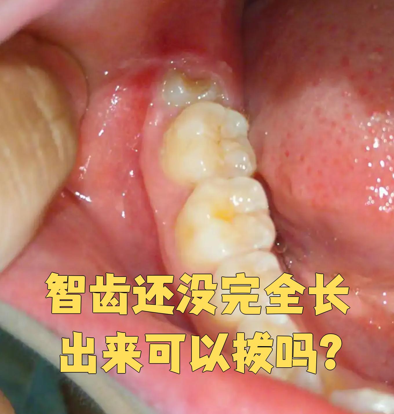 长智齿图片(长智齿是什么样子图片)