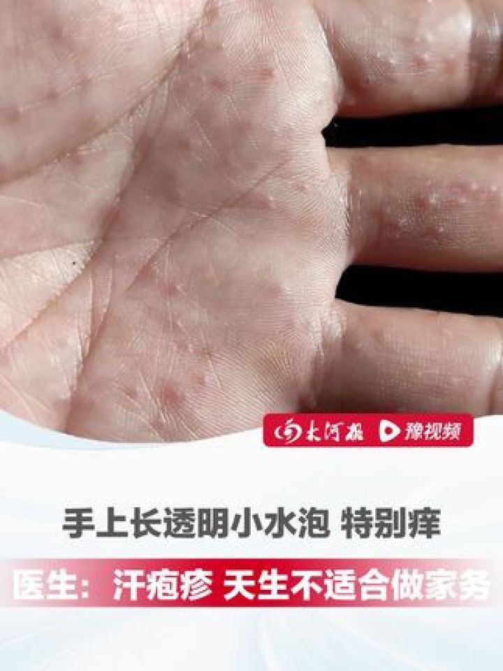 水泡型疱疹图片(腰部水泡型疱疹图片) 水泡型疱疹图片(腰部水泡型疱疹图片)