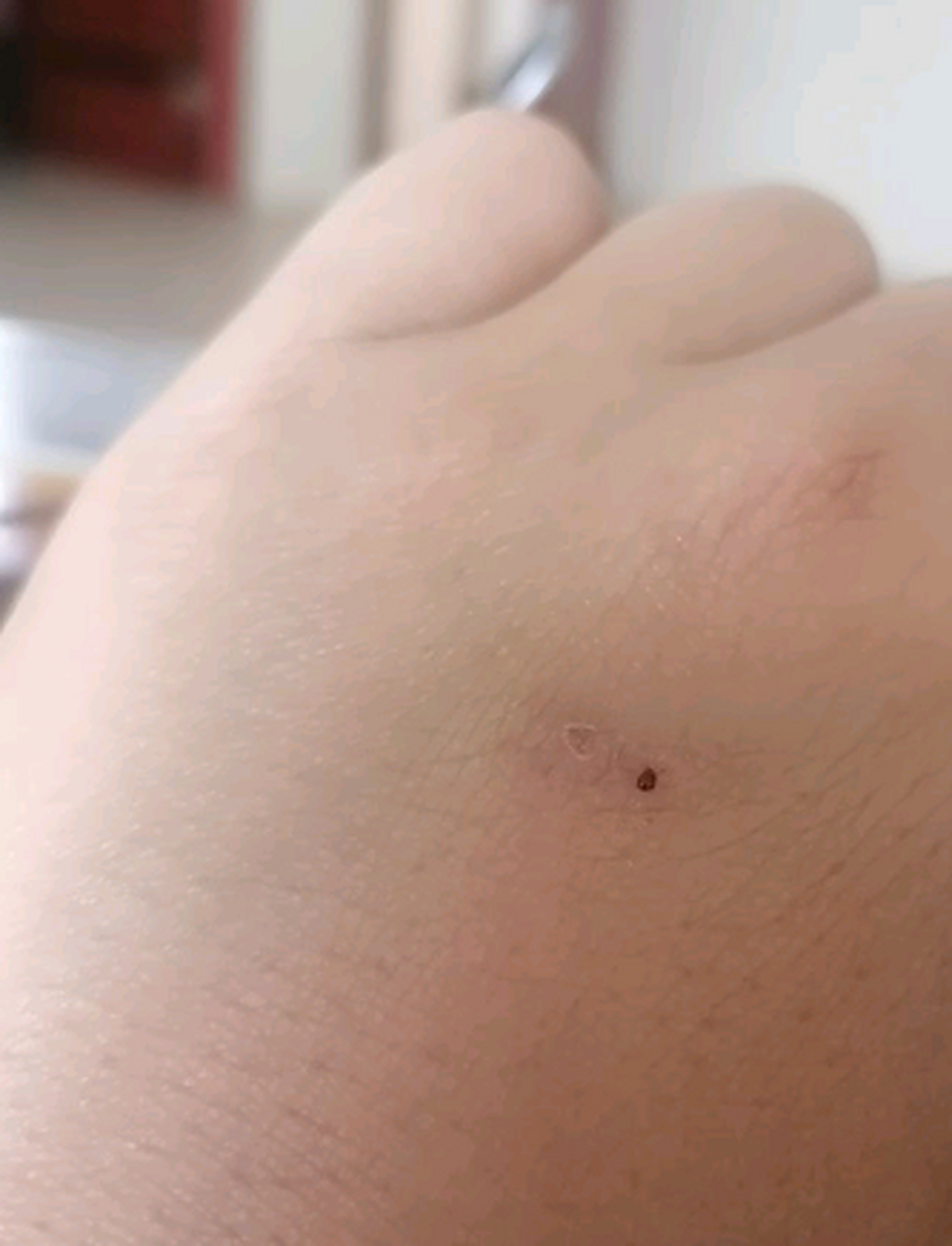 梦到被蛇咬到手(梦到被蛇咬到手了)