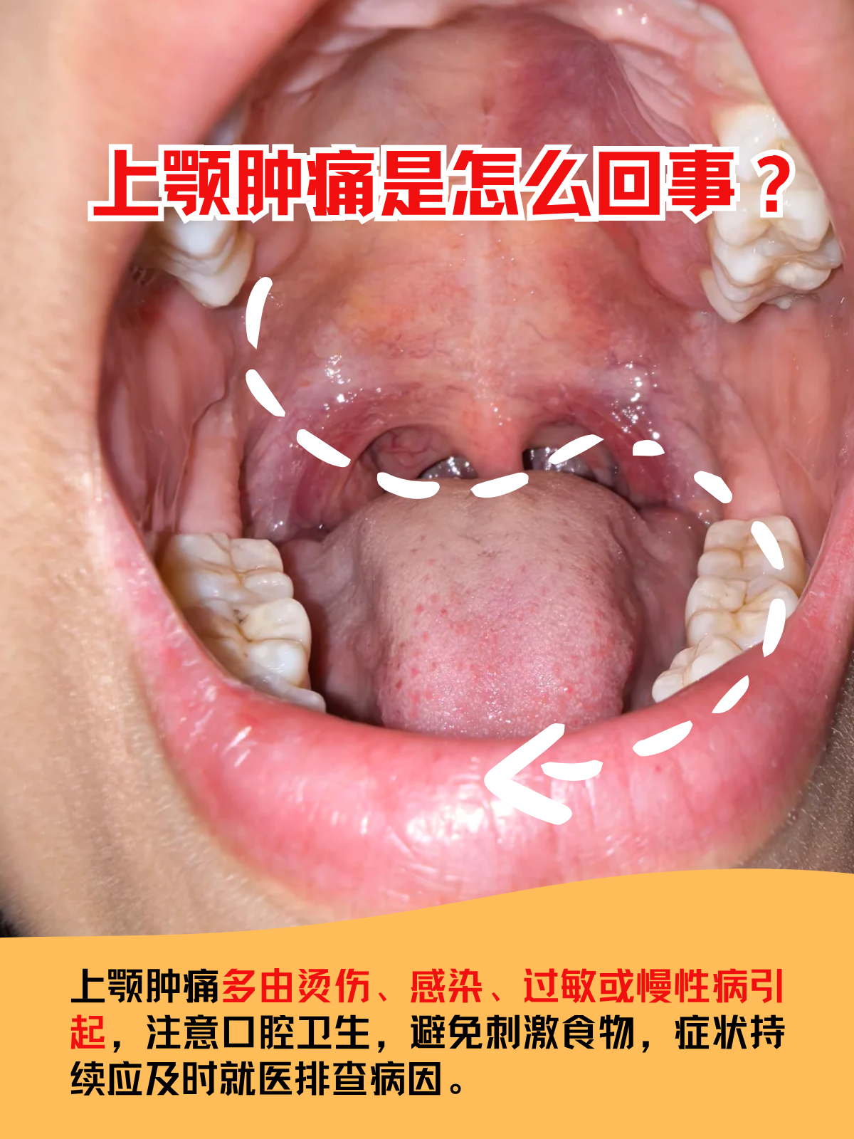 上颚图片(手足口病上颚图片)