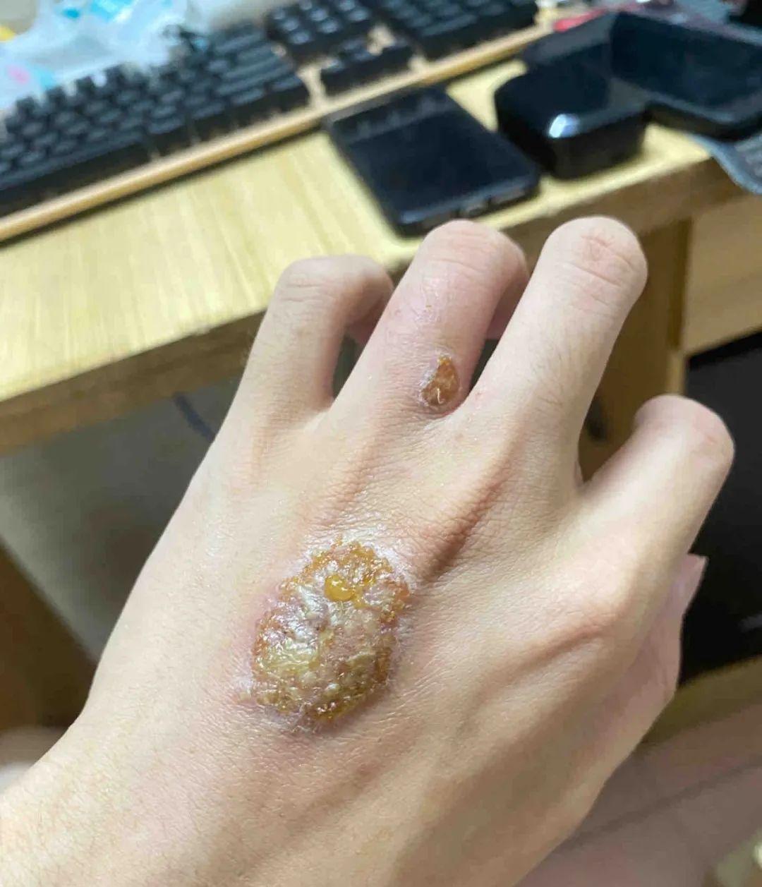 金钱癣图片(金钱癣用什么药膏)