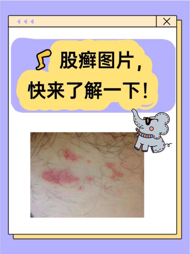 金钱癣图片(金钱癣用什么药膏)