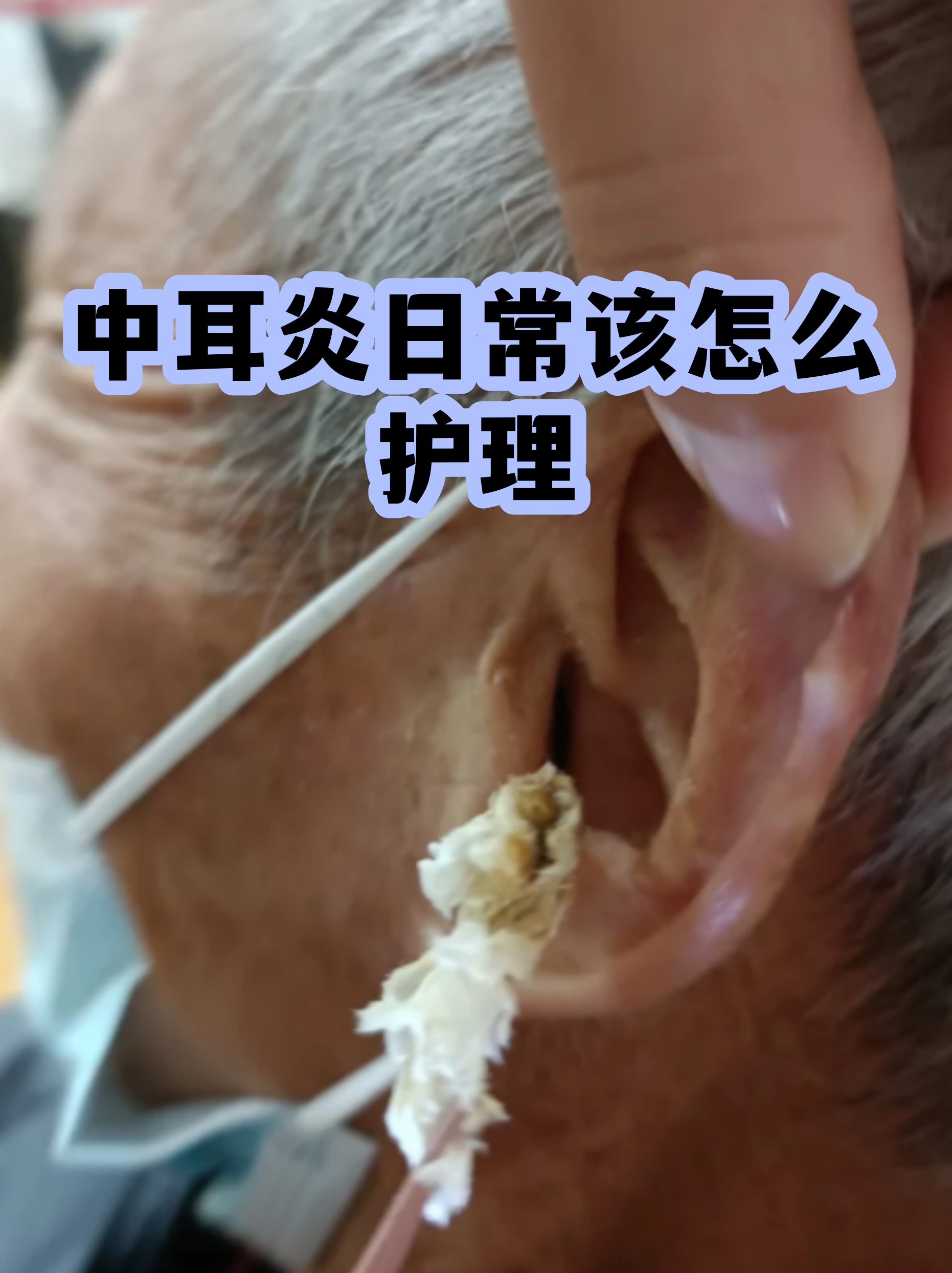 婴儿中耳炎初期图片(婴儿中耳炎图片 初期)