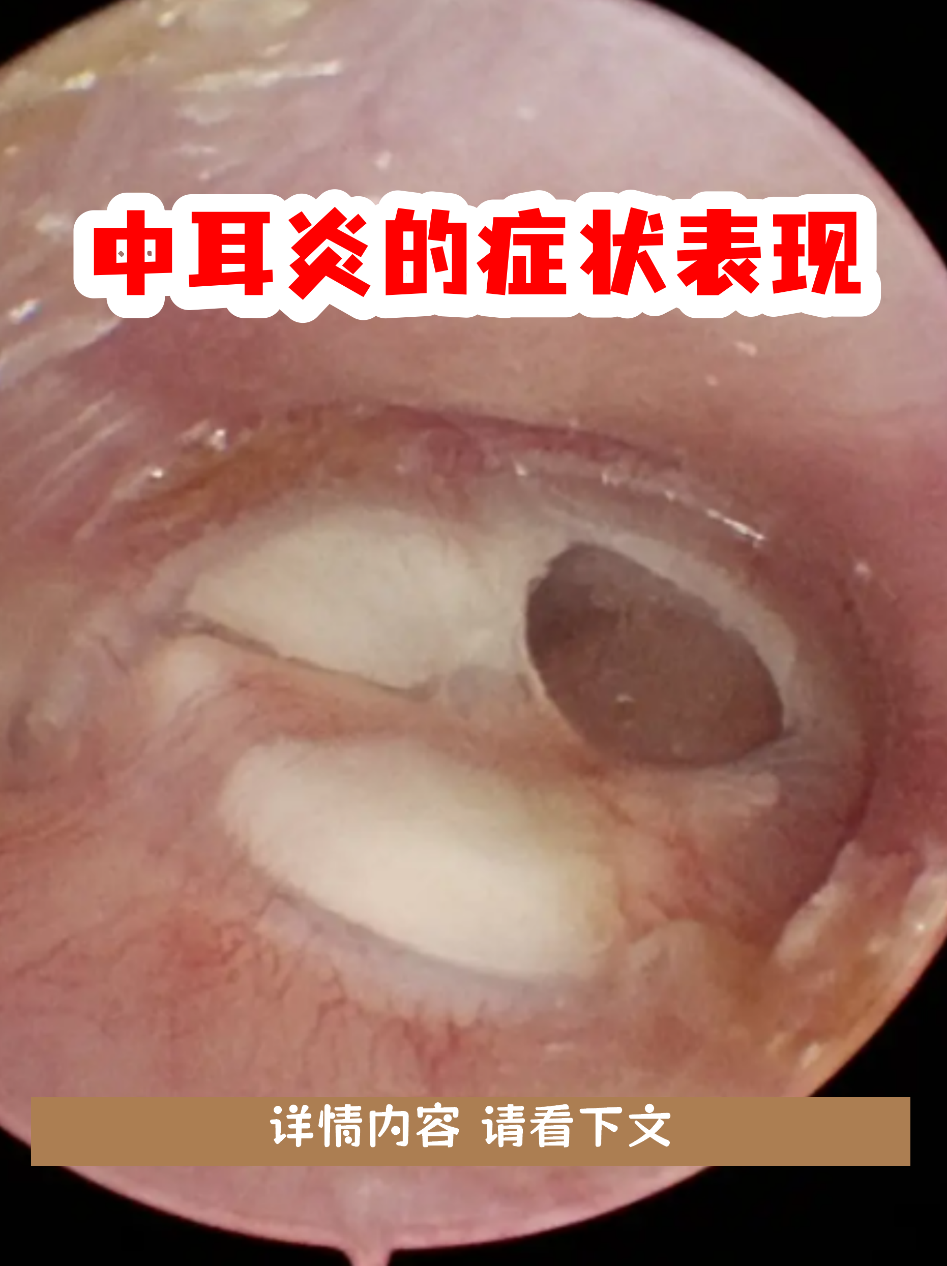 婴儿中耳炎初期图片(婴儿中耳炎图片 初期) 婴儿中耳炎初期图片(婴儿中耳炎图片 初期)