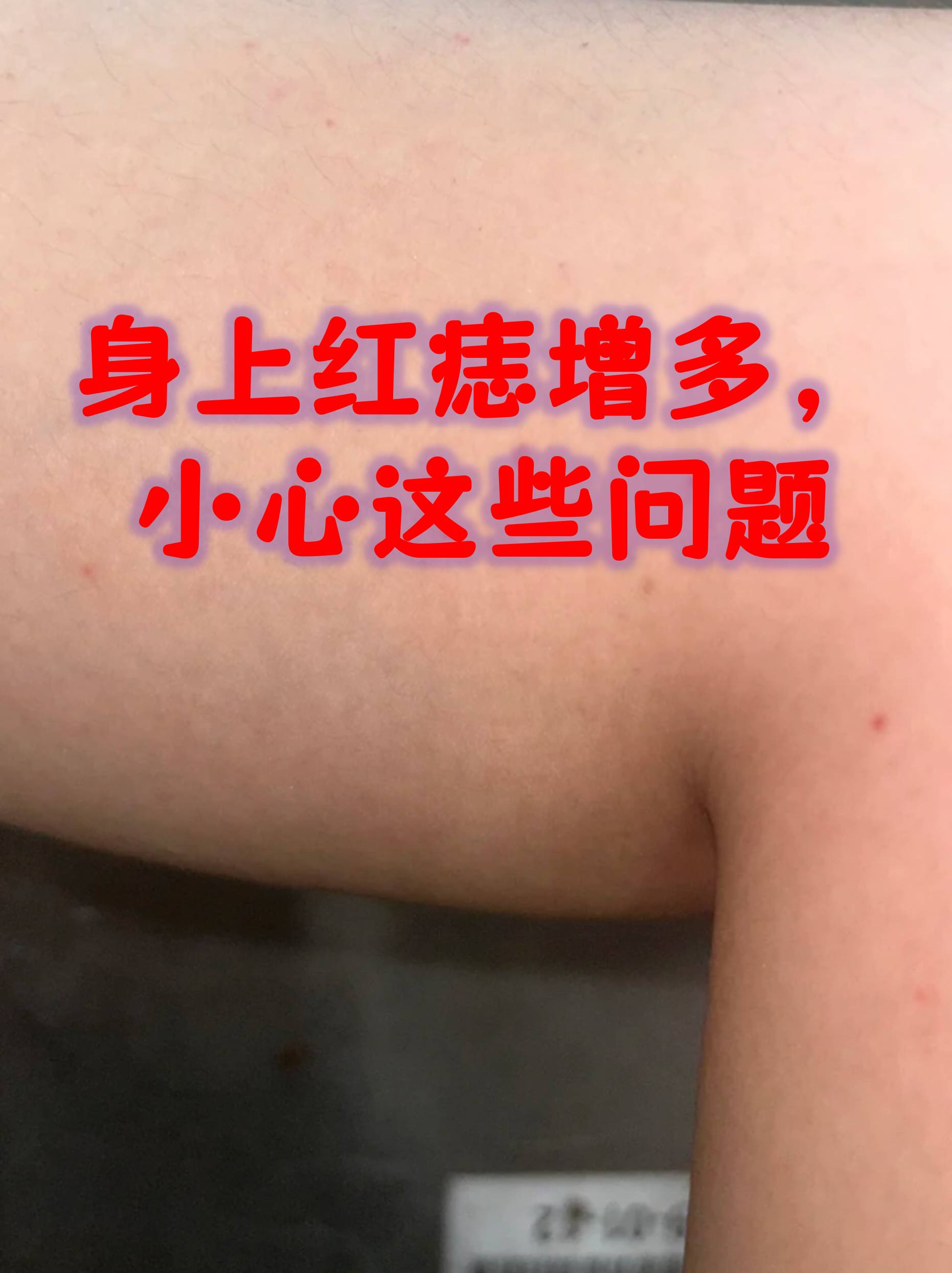 蜘蛛痣的超清图片(蜘蛛痣的超清图片高清)