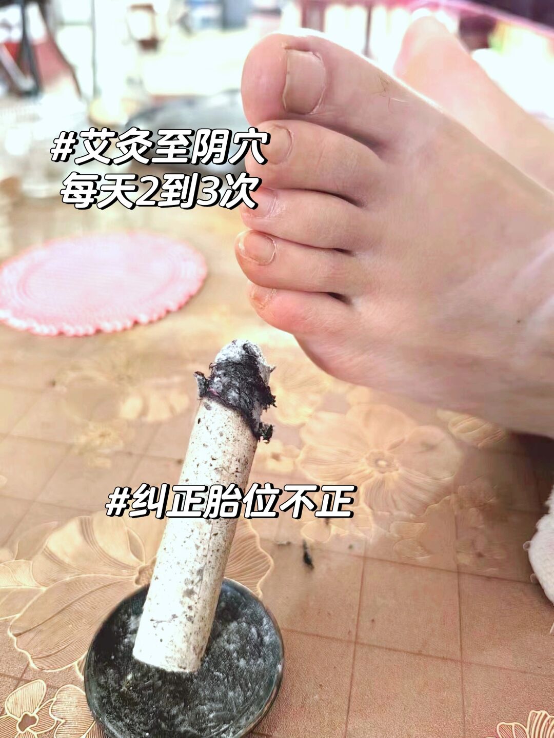 至阴穴(至阴放血好处)