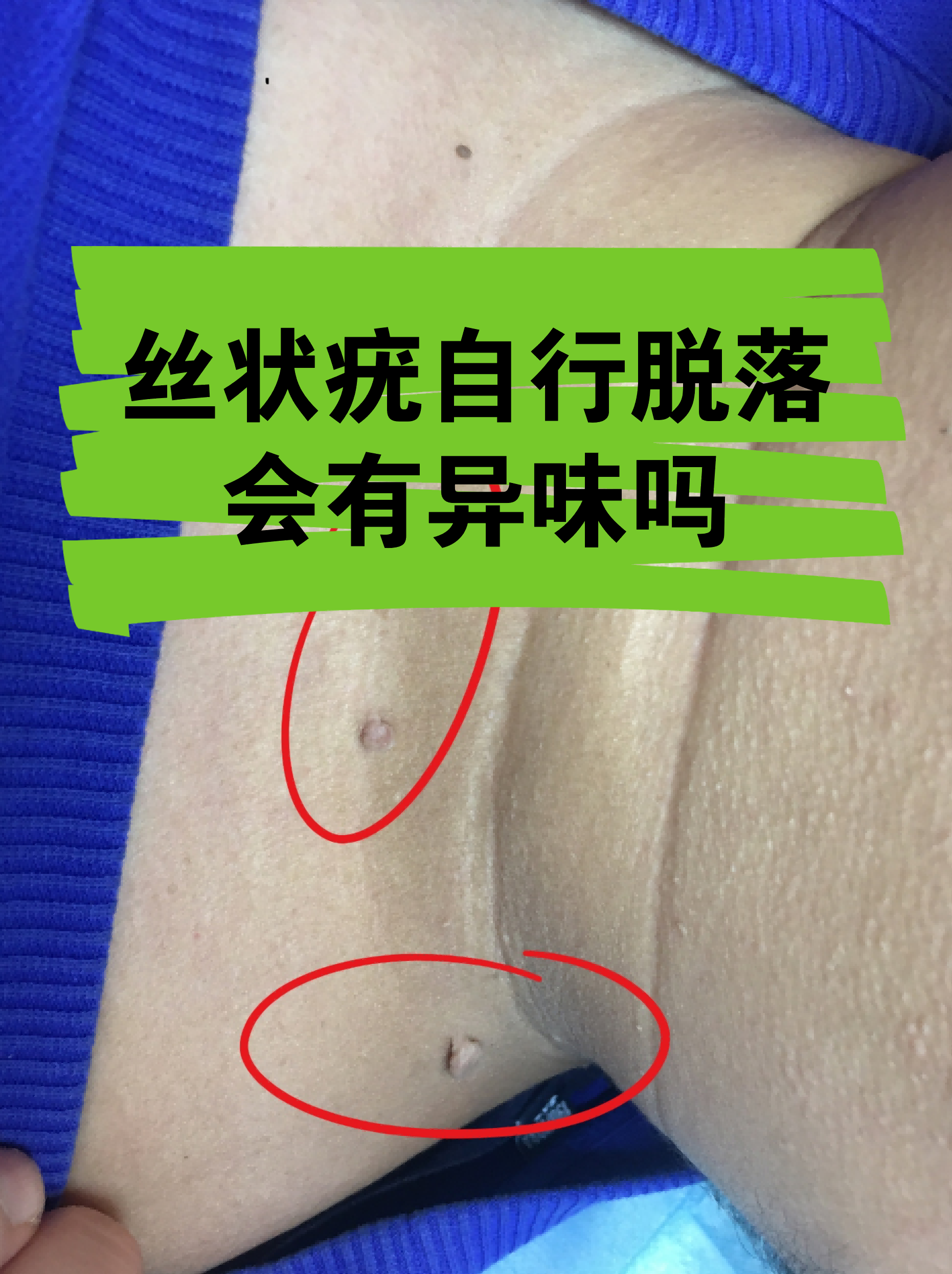 初期小疣体图片真实(初期小疣体容易抠掉吗)