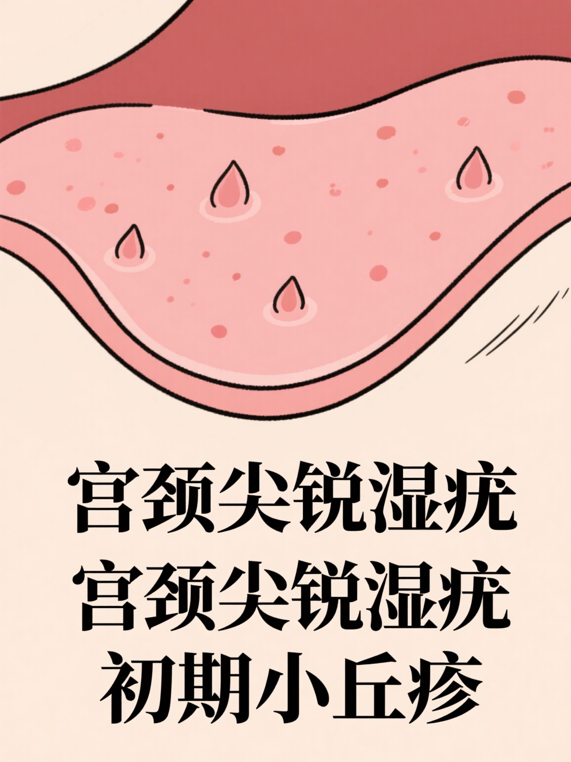 湿锐尤早期图片(湿锐尤是什么引起的)