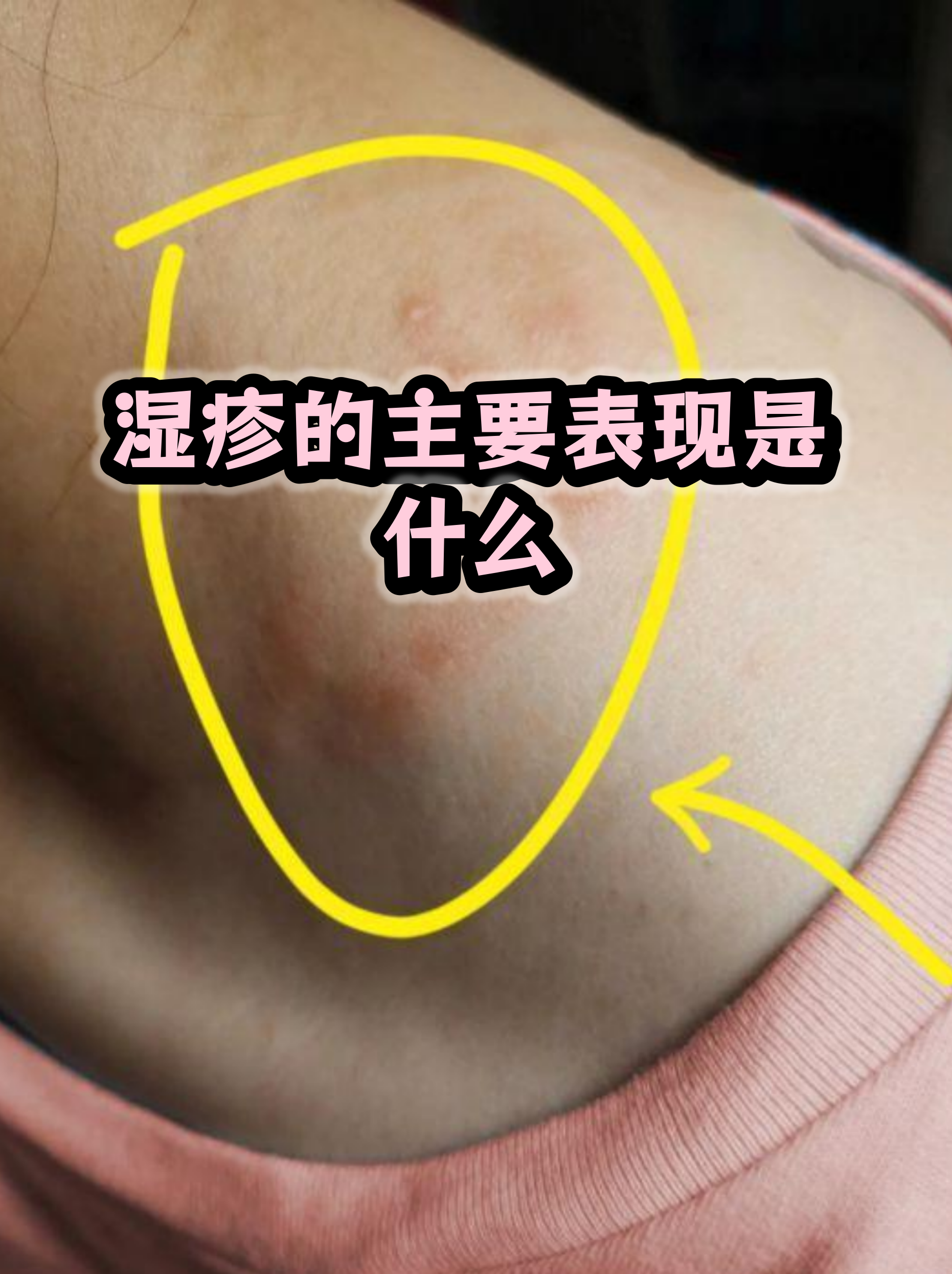 男性湿疹图片(男性湿疹图片大全)