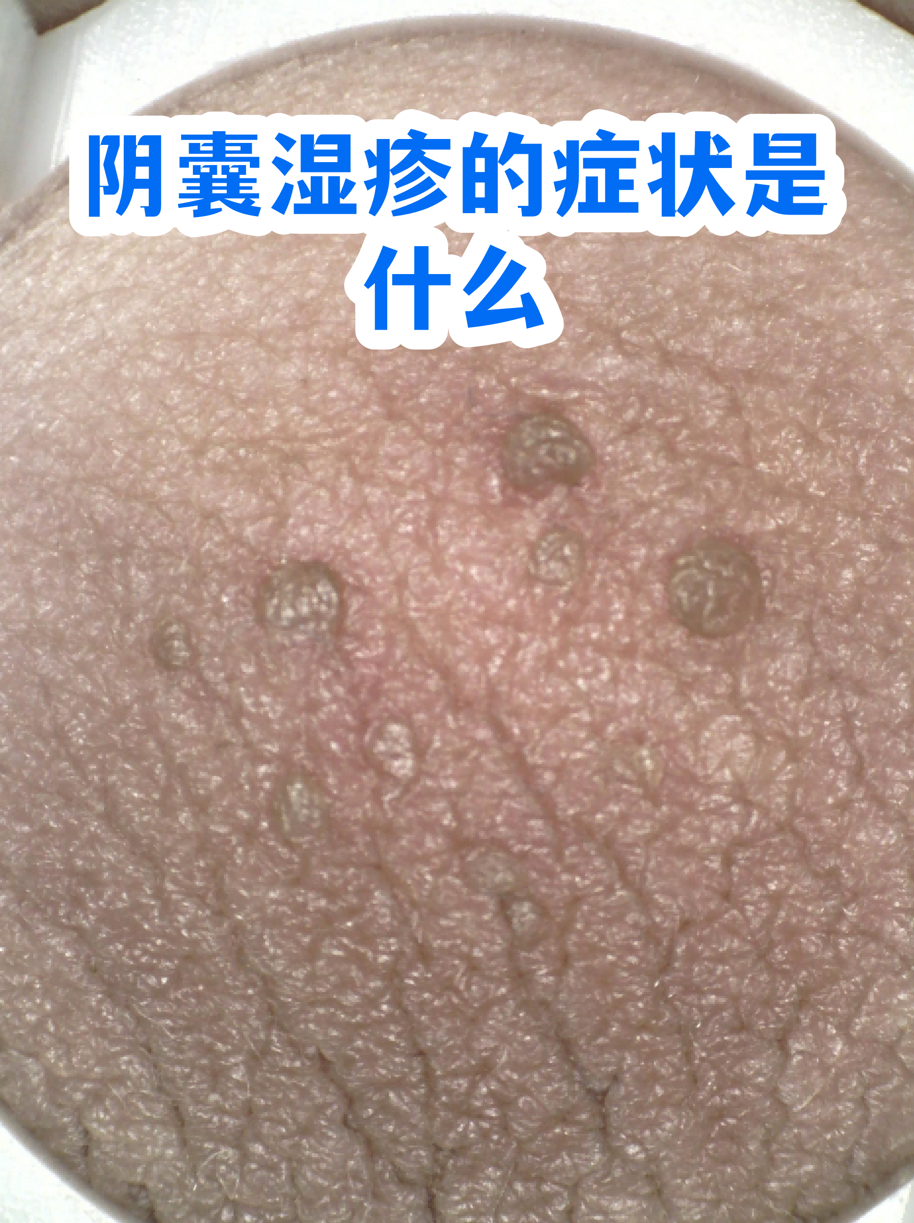 男性湿疹图片(男性湿疹图片大全) 男性湿疹图片(男性湿疹图片大全)