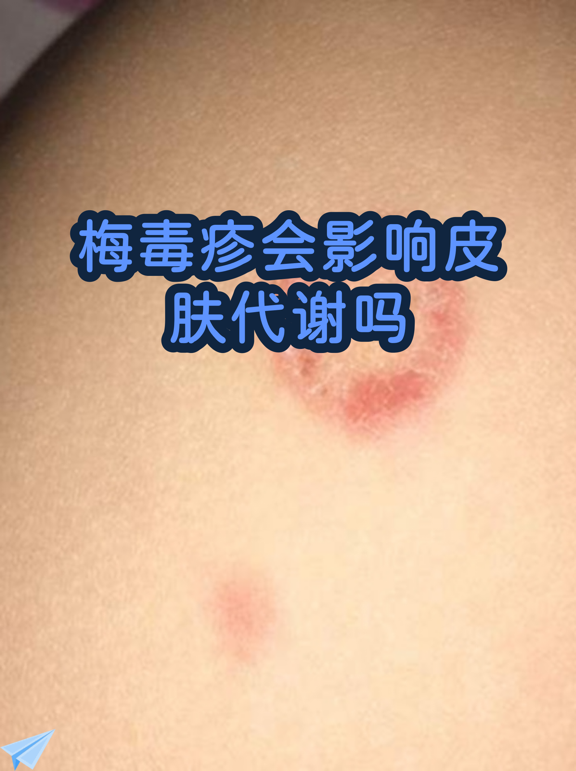 梅毒疹图片大全(梅毒疹图片大全 初期)