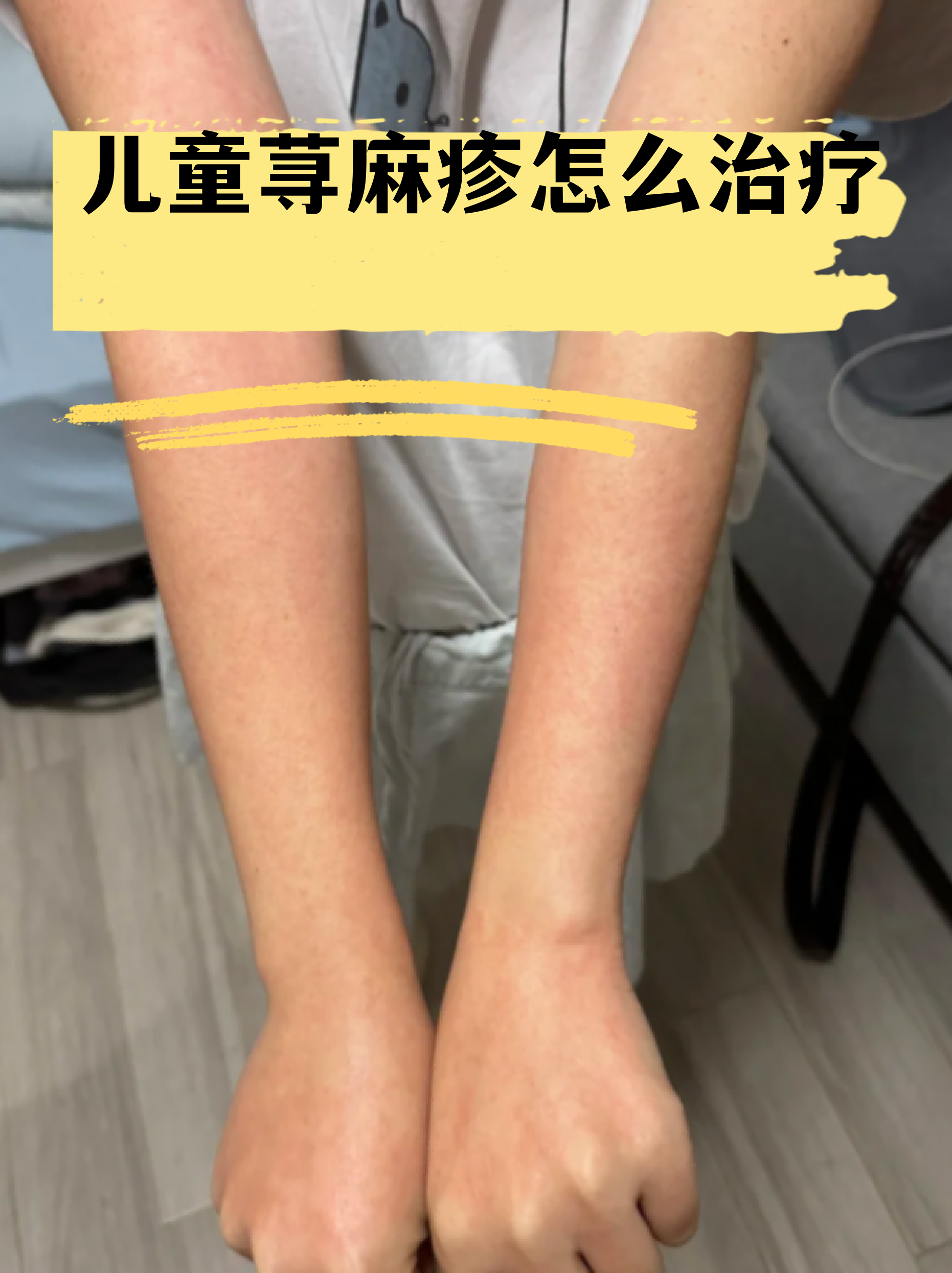 小儿荨麻疹照片(小儿荨麻疹图片和症状图片)