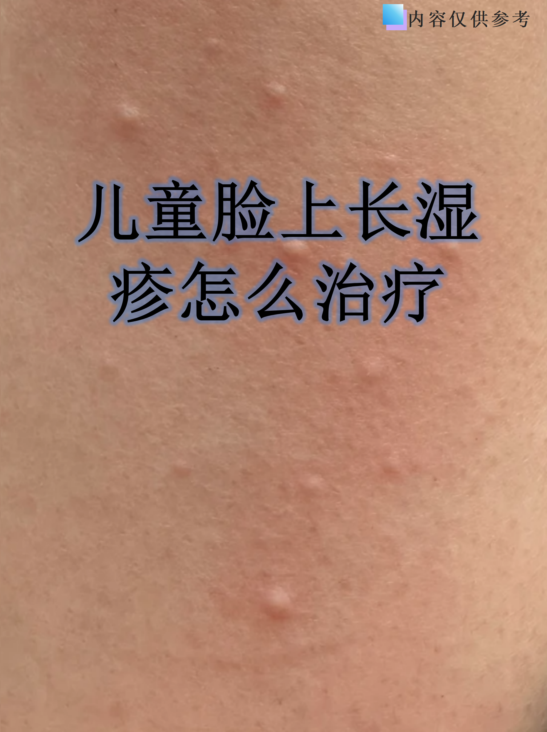 干裂性湿疹图片(干性湿疹的七种图片)