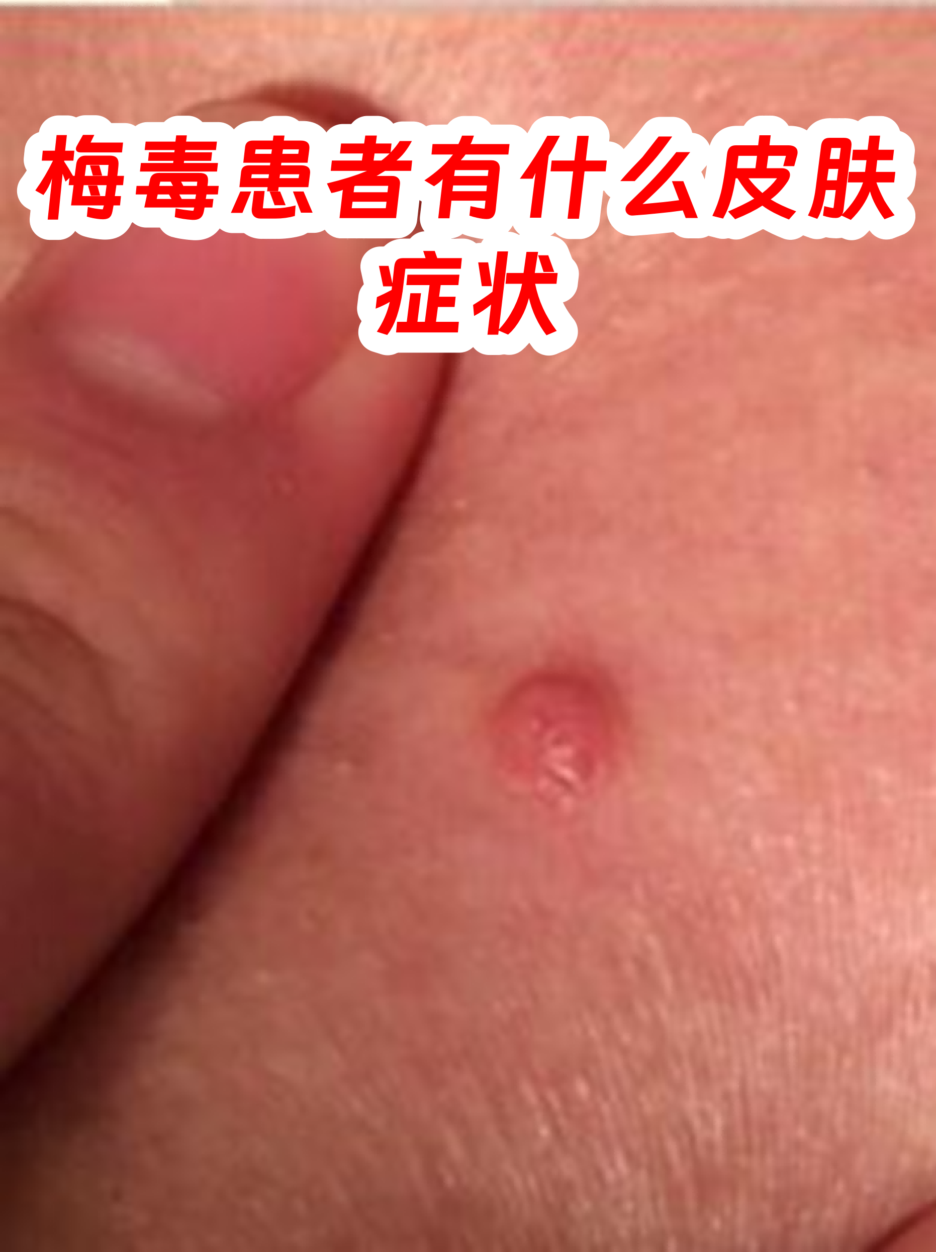 梅毒早期皮肤症状图片(梅毒初期症状皮疹图片有异味马)