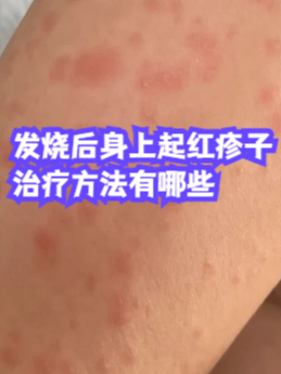 病毒疹图片(病毒疹图片和症状图片)