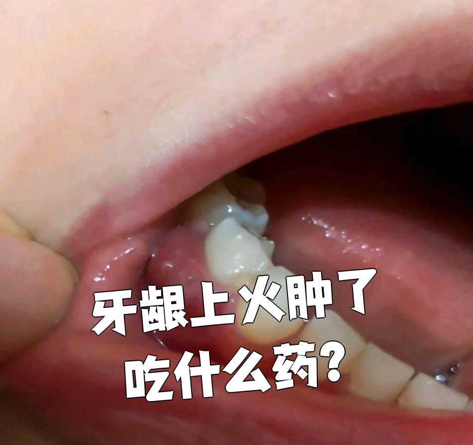 牙龈发炎图片(牙龈发炎图片症状图片)