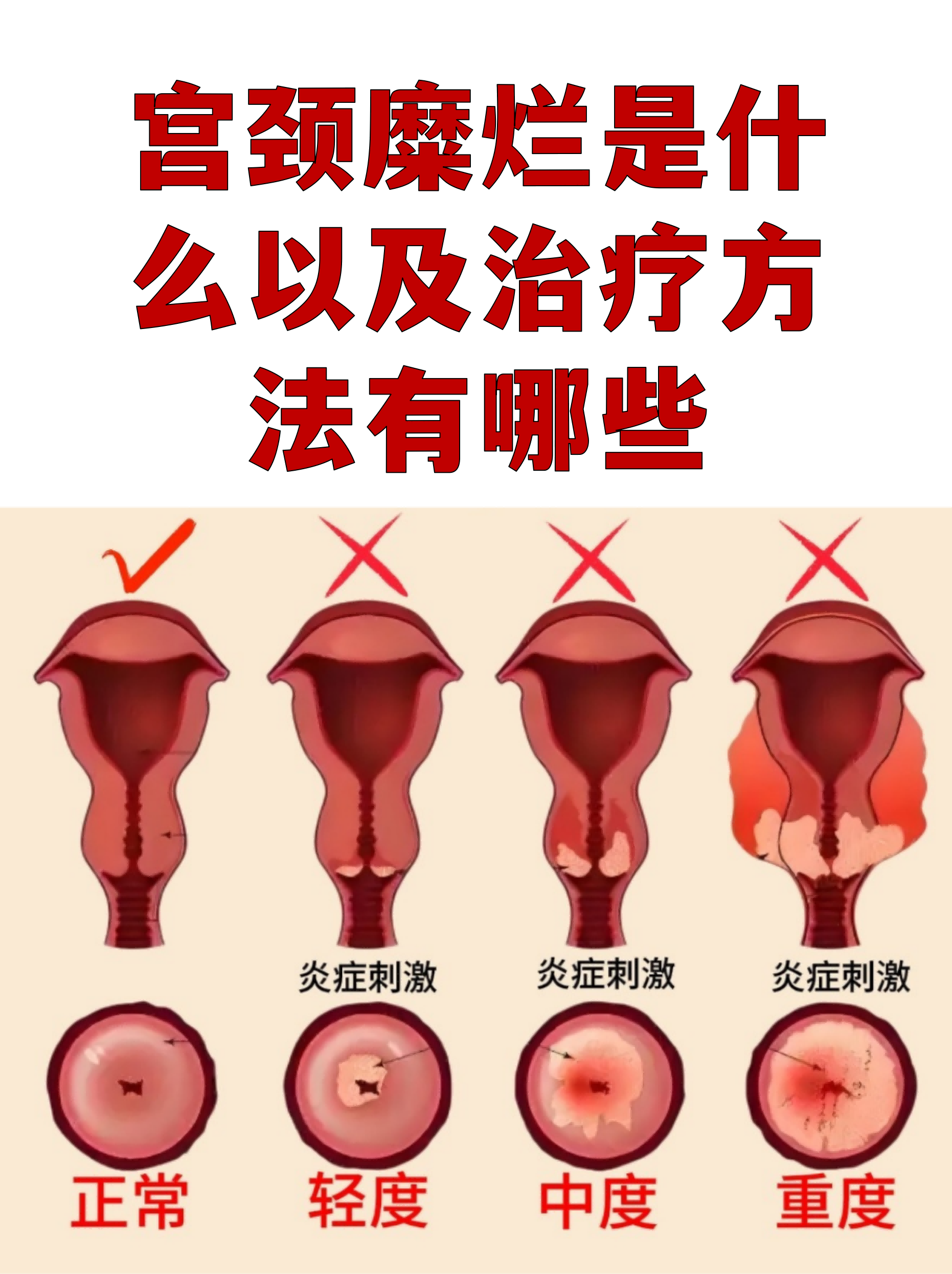 正常的宫颈图片(正常的宫颈图片对比第1页)