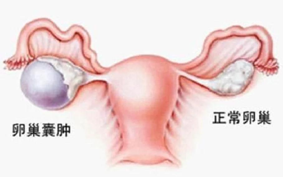 囊肿妇科图片(囊肿妇科图片高清)