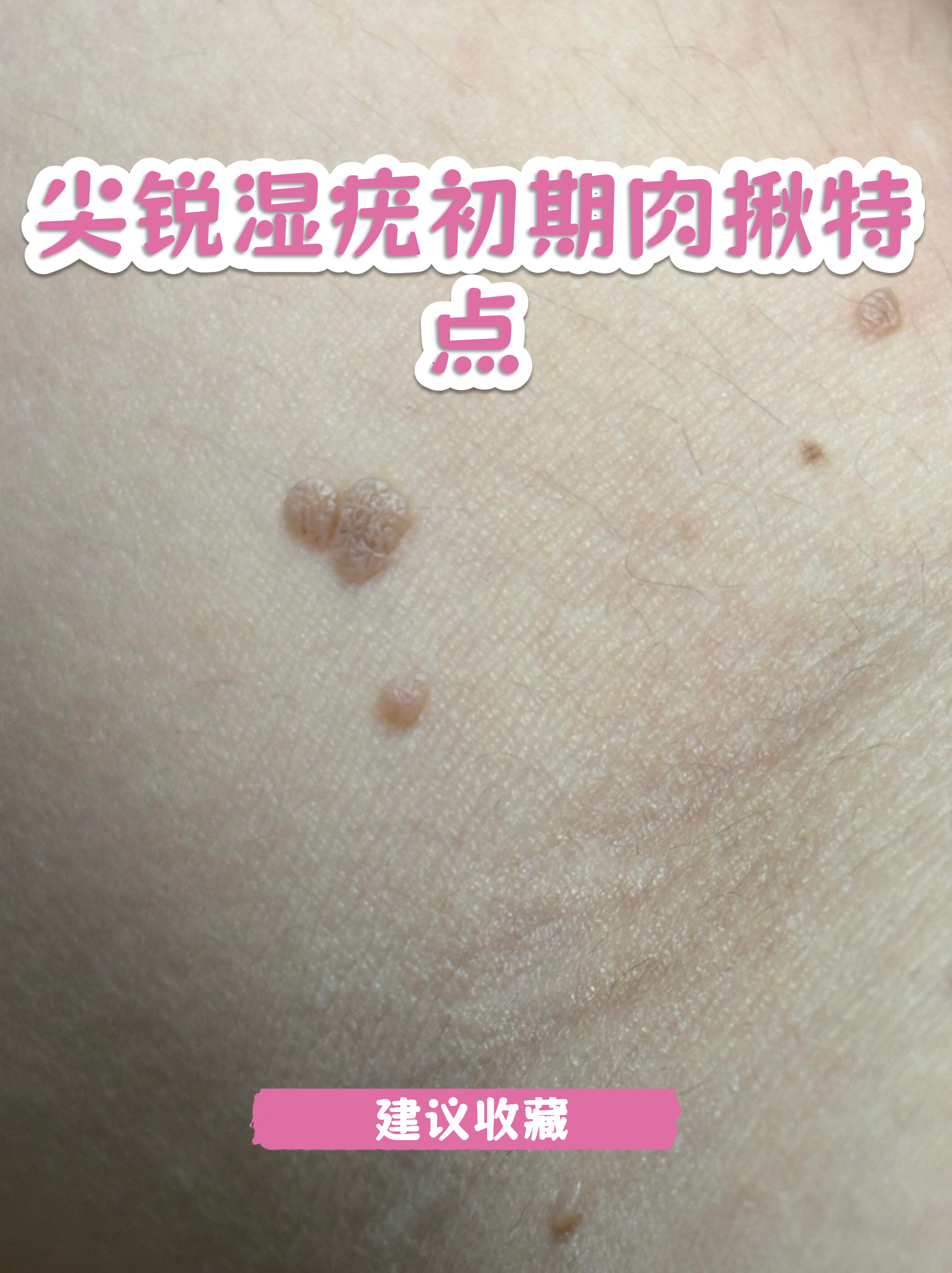女性菜花状疣图片(尖锐湿疣的症状和图片)