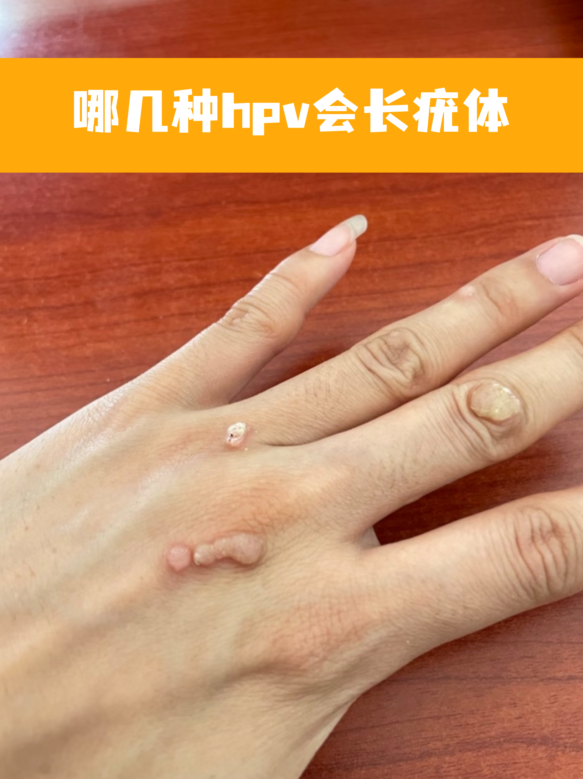 女性菜花状疣图片(尖锐湿疣的症状和图片)