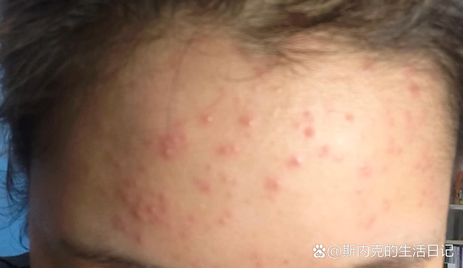 脸上长荨麻疹的图片(脸上长荨麻疹的图片大全)