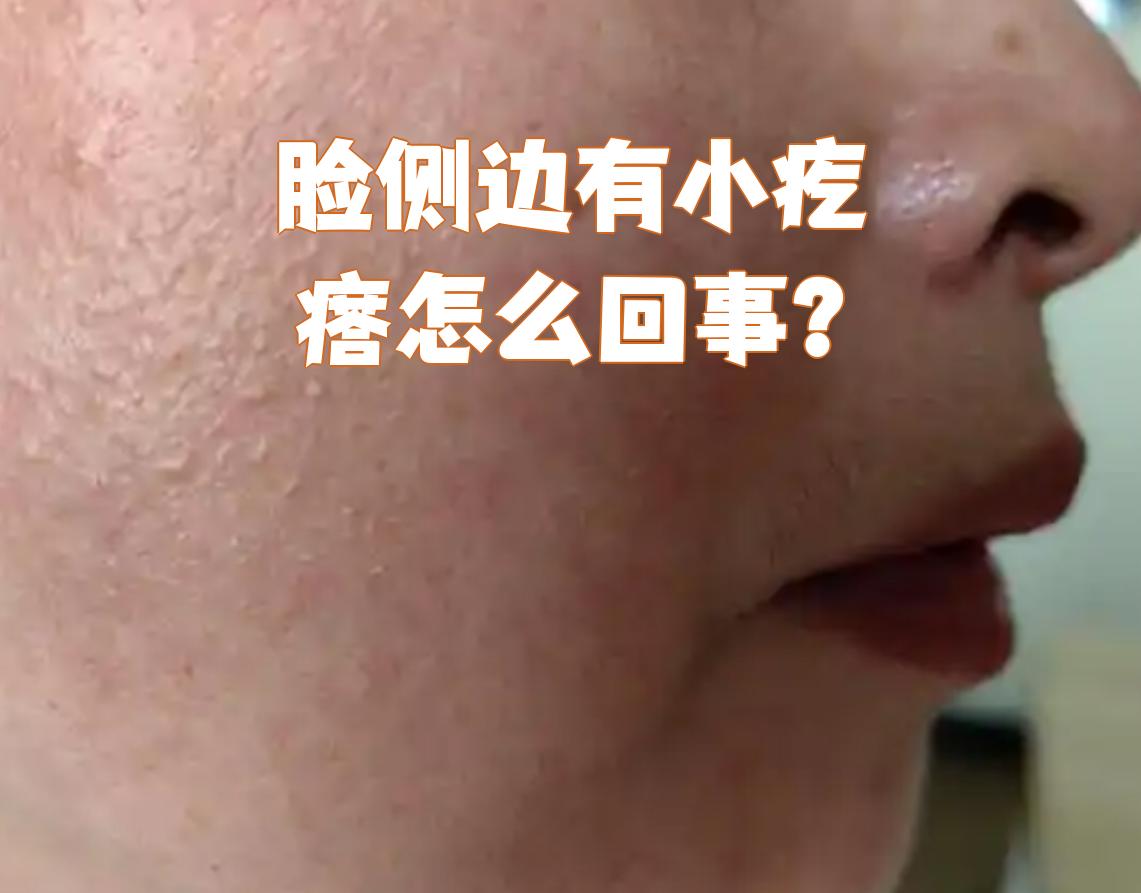 毛周角化症图片脸部两侧(毛周角化是什么图片 脸上) 毛周角化症图片脸部两侧(毛周角化是什么图片 脸上)