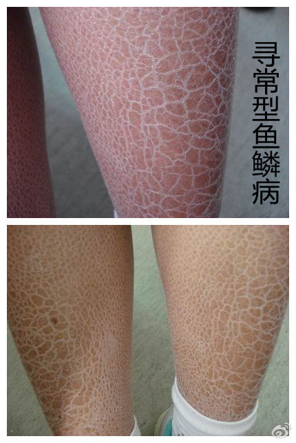 糙皮病症状图片(糙皮病的临床表现)