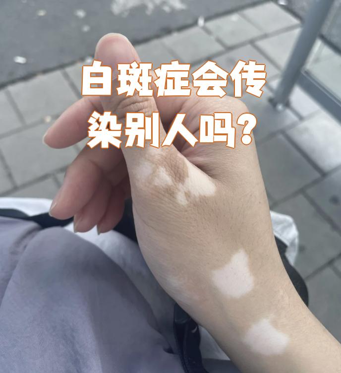 梅毒性白斑图片(梅毒性白斑图片女性)