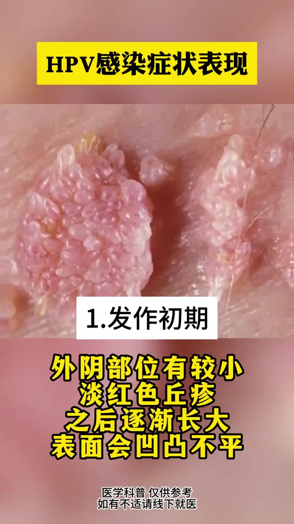 hpv图片症状图片大全(hpv图片症状图片大全女性) hpv图片症状图片大全(hpv图片症状图片大全女性)