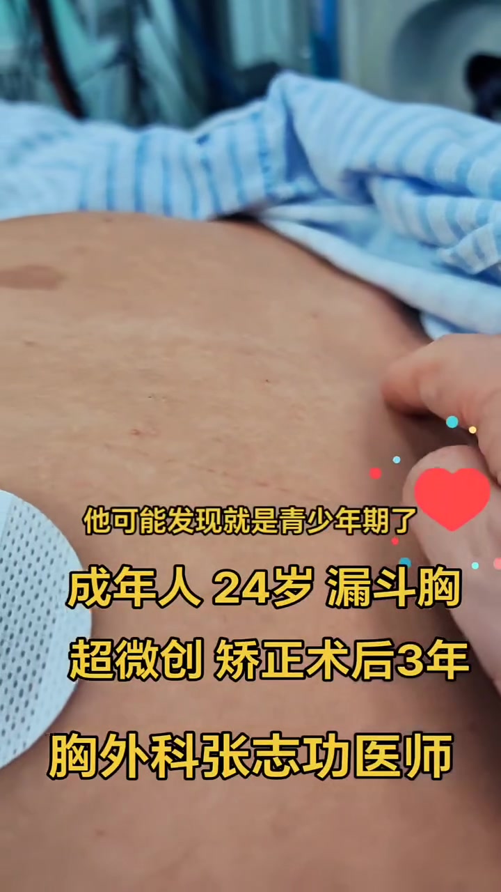 漏斗胸的图片(婴儿轻度漏斗胸的图片)
