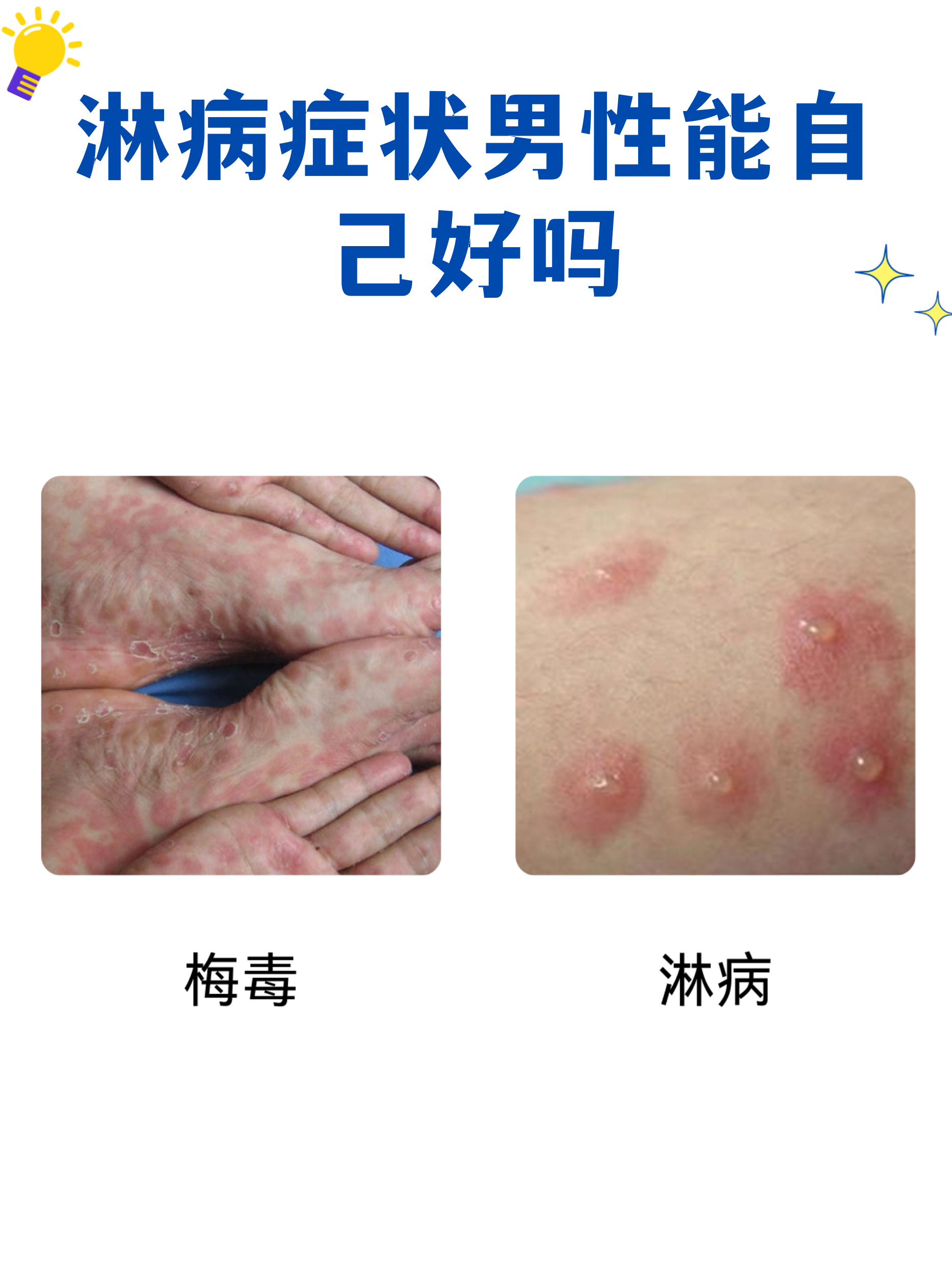 性疾病菜花头图片(什么是菜花型病变?)