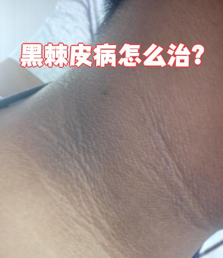 身上皮肤出现黑块图片(身上皮肤出现黑斑是什么病)