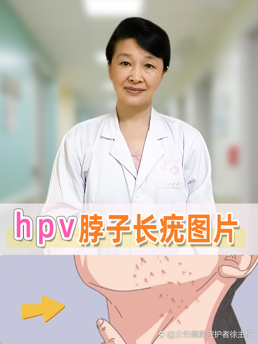 hpv长疣体什么样子的图片(hpv长疣体了是恶变的意思吗)