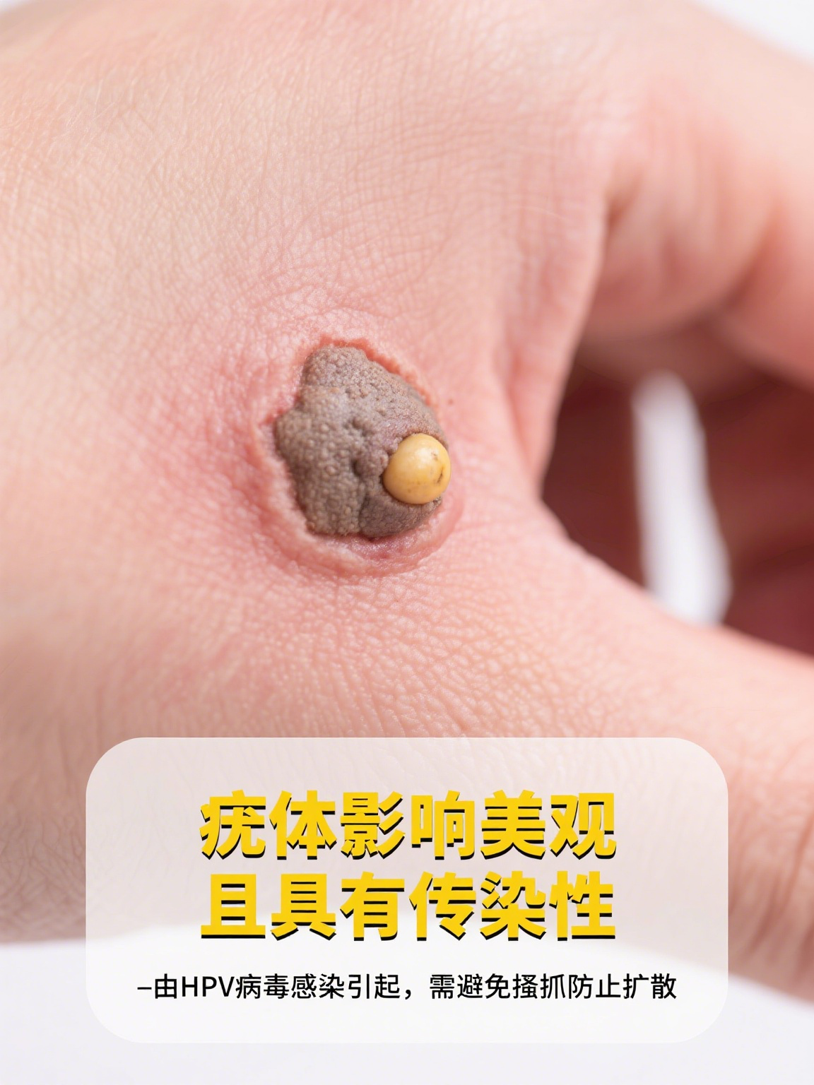 hpv长疣体什么样子的图片(hpv长疣体了是恶变的意思吗) hpv长疣体什么样子的图片(hpv长疣体了是恶变的意思吗)