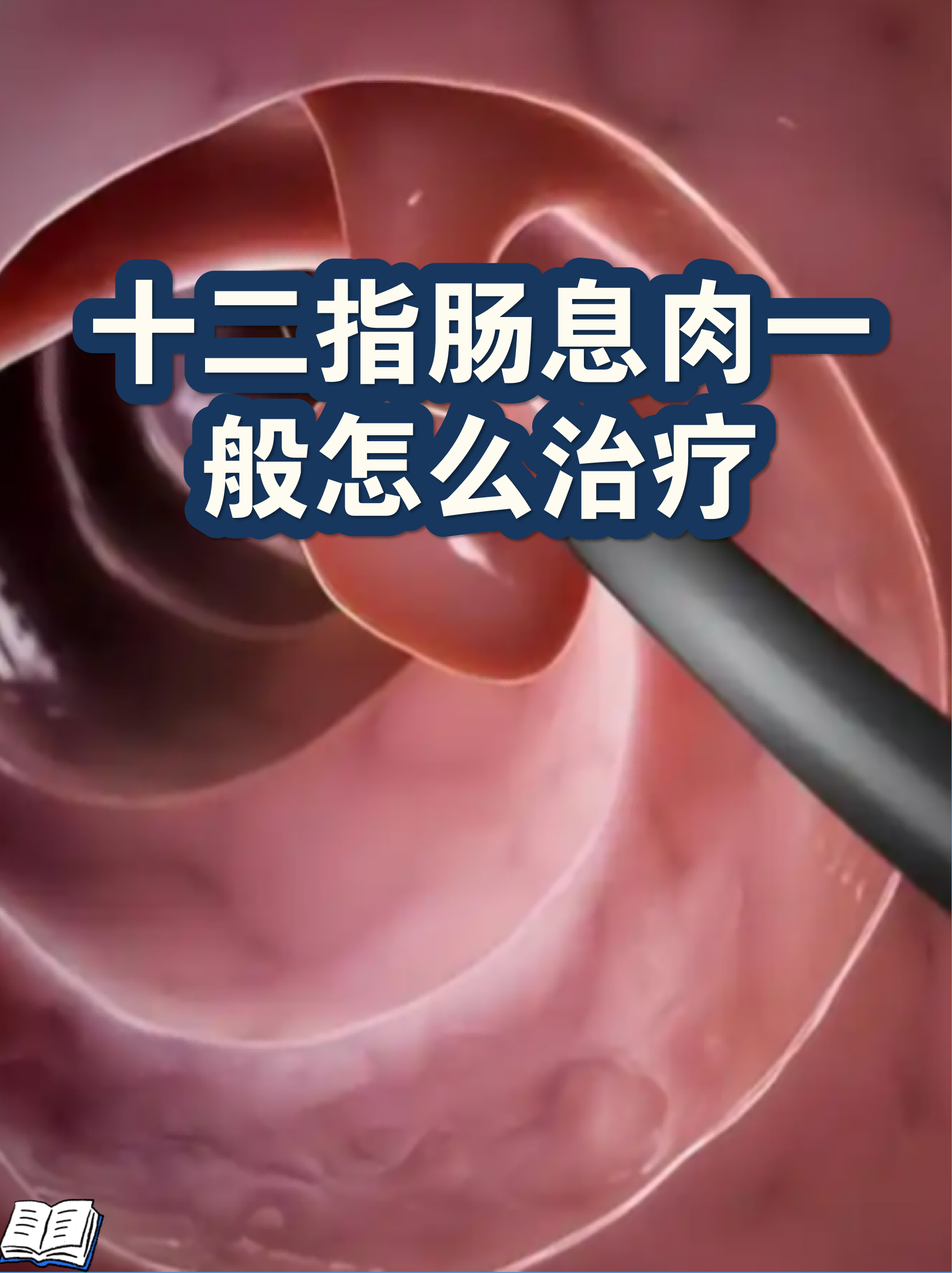 十二指肠球部位置图(十二指肠在肚脐位置图)