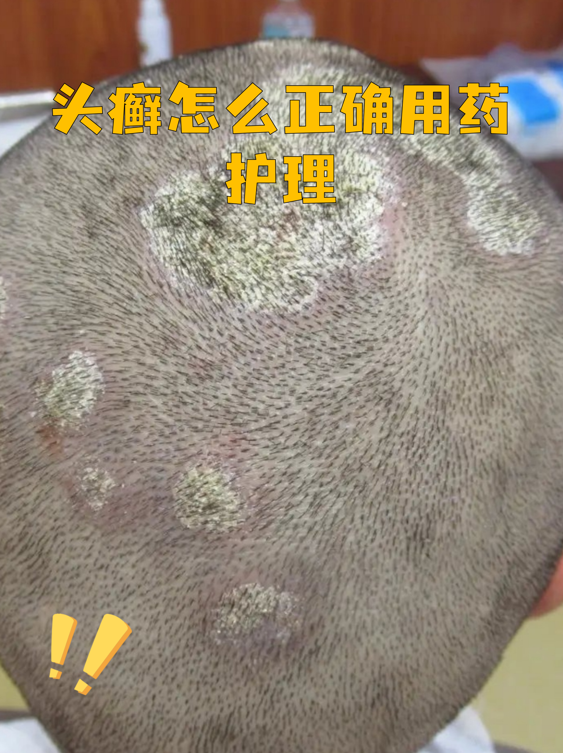 儿童头癣的初期图片(头上一层白皮一抠就变头屑)