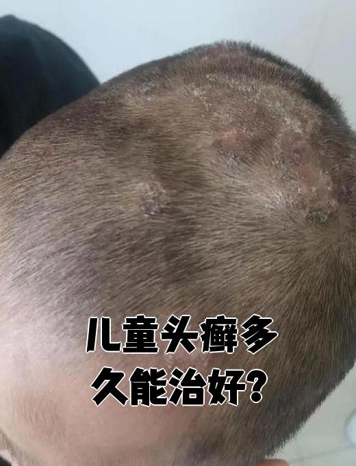儿童头癣的初期图片(头上一层白皮一抠就变头屑)