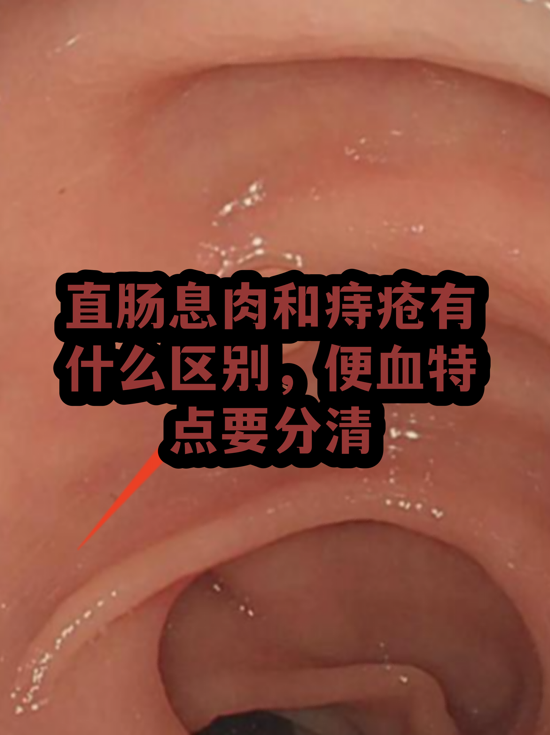 痔疮粘液图片(痔疮有粘液是怎么回事)