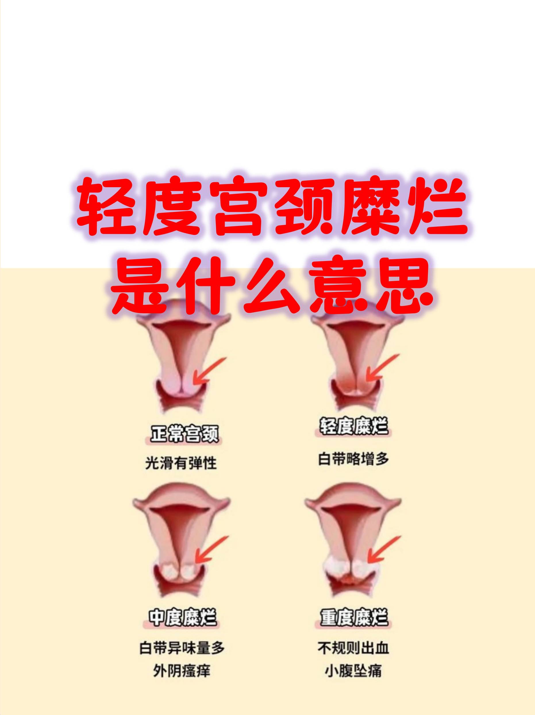 正常宫颈图片(宫颈糜烂图片和正常宫颈图片)