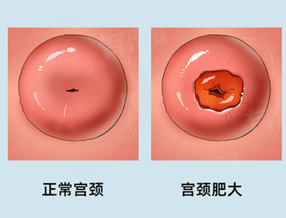 正常宫颈图片(宫颈糜烂图片和正常宫颈图片)