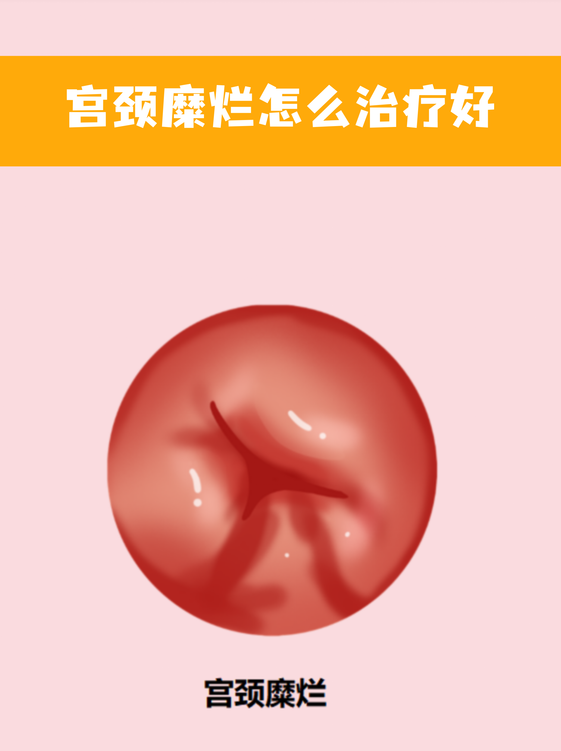 宫颈糜烂一到三度图片(宫颈糜烂一二三度图片 白带)