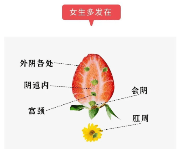 下体图片(丝状疣女性下体图片)
