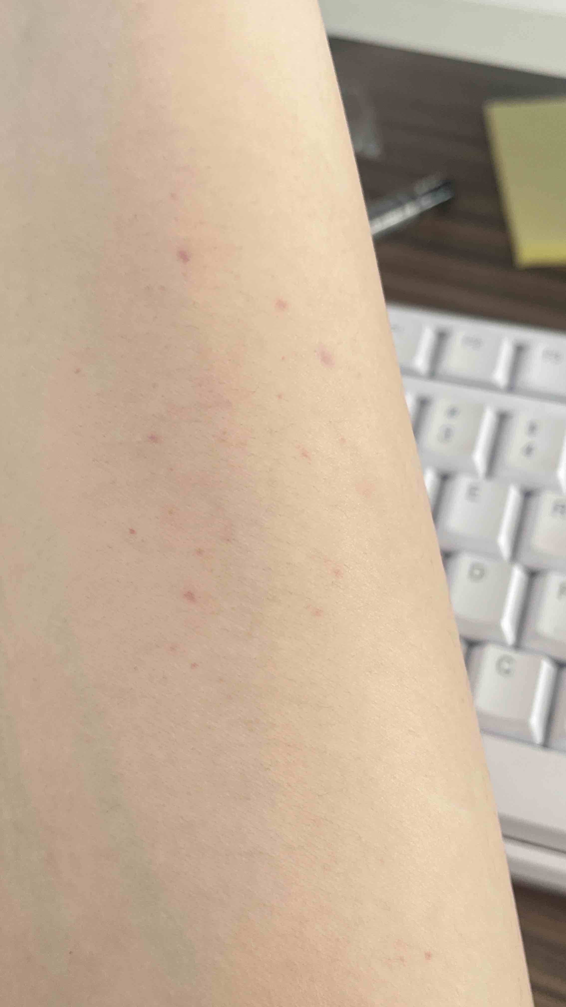单纯性紫癜初期的图片(单纯性紫癜初期的图片和症状)