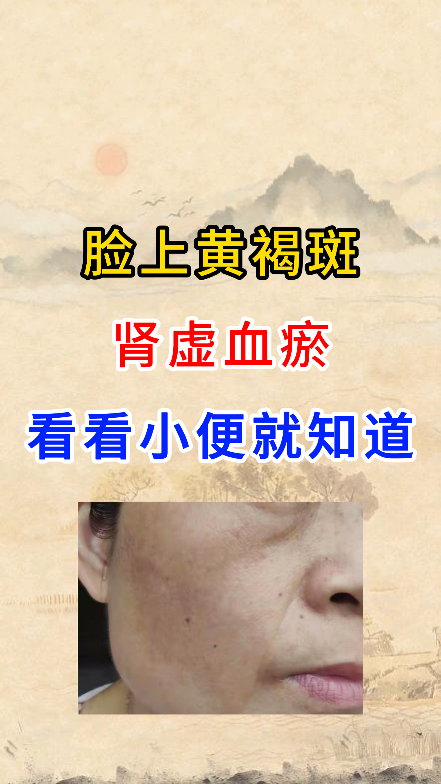 肝斑图片(乙肝肝斑图片)